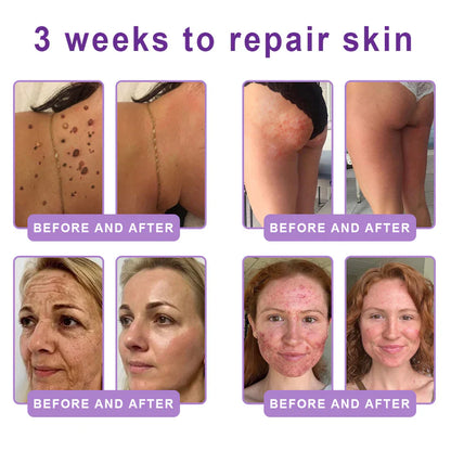 ✨LAST DAY BUY 1 GET 1 FREE✨ HISKIN PDRN Multi-Peptide Massaging Body RollerCream Visibly Firmer Anti-aging, Lifted Skin in 72 Hours — No Needles, No Clinic Visits