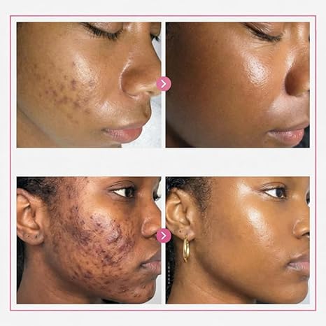 🔥Limited Time Offer🔥Tranexamic Acid Cream for Face & Body