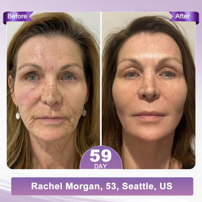 ✨LAST DAY BUY 1 GET 1 FREE✨ HISKIN PDRN Multi-Peptide Massaging Body RollerCream Visibly Firmer Anti-aging, Lifted Skin in 72 Hours — No Needles, No Clinic Visits