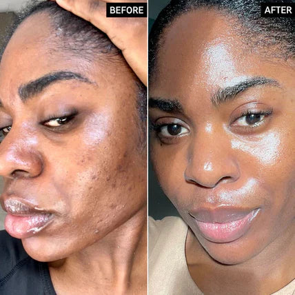 🔥Limited Time Offer🔥Tranexamic Acid Cream for Face & Body