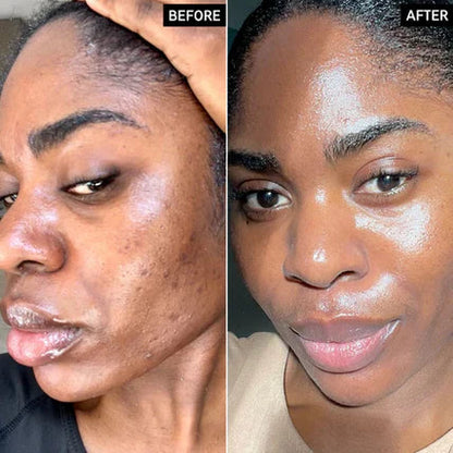 🔥Limited Time Offer🔥Tranexamic Acid Cream for Face & Body