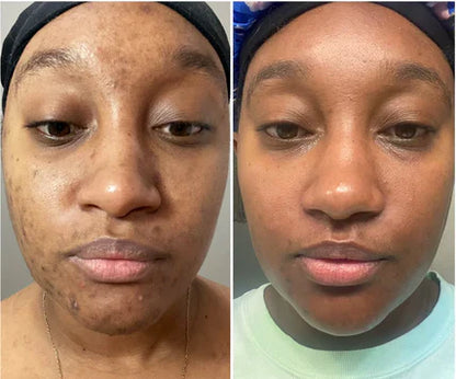 🔥Limited Time Offer🔥Tranexamic Acid Cream for Face & Body