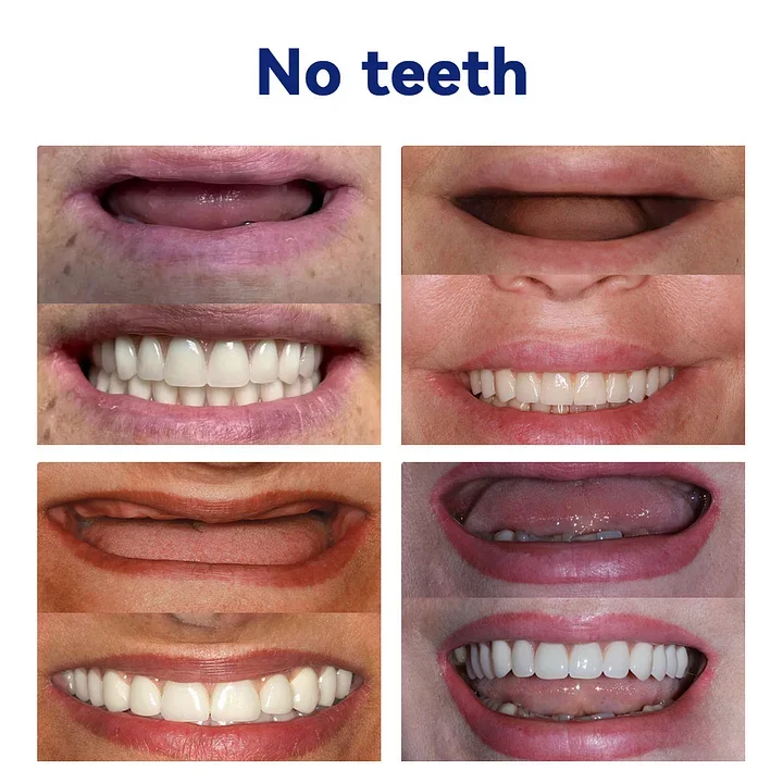 NESLEMY-🦷Advanced Customized Full Denture Set🦷